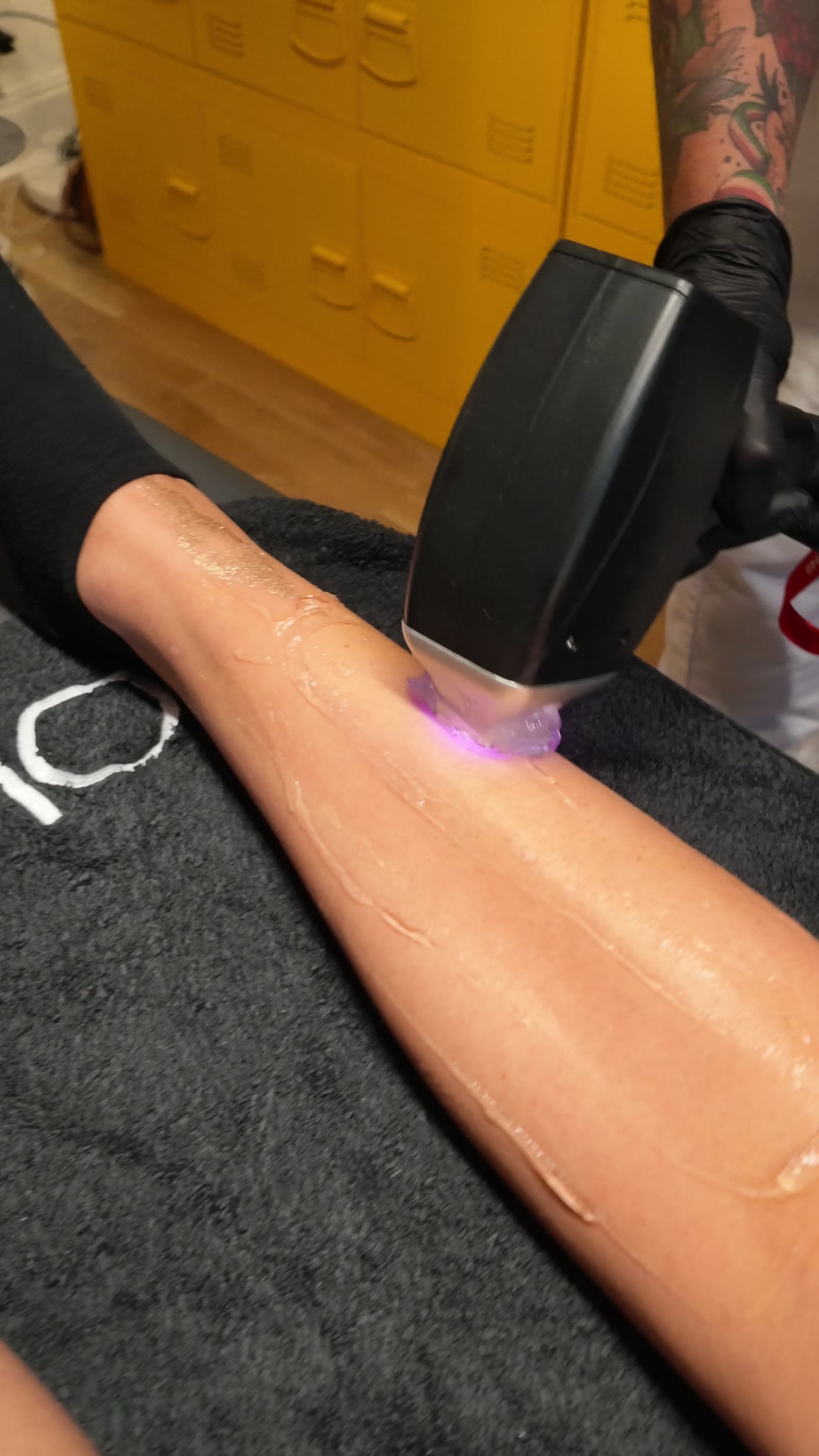 Diodlaserns handstycke arbetar längs benet under behandling hos Esperitu Estetik